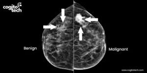 Mammogram Data Annotation for AI-Driven Breast...