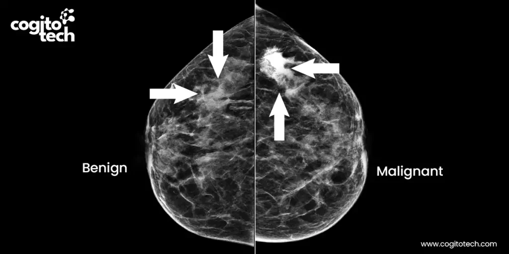 Mammogram Data Annotation for AI-Driven Breast...
